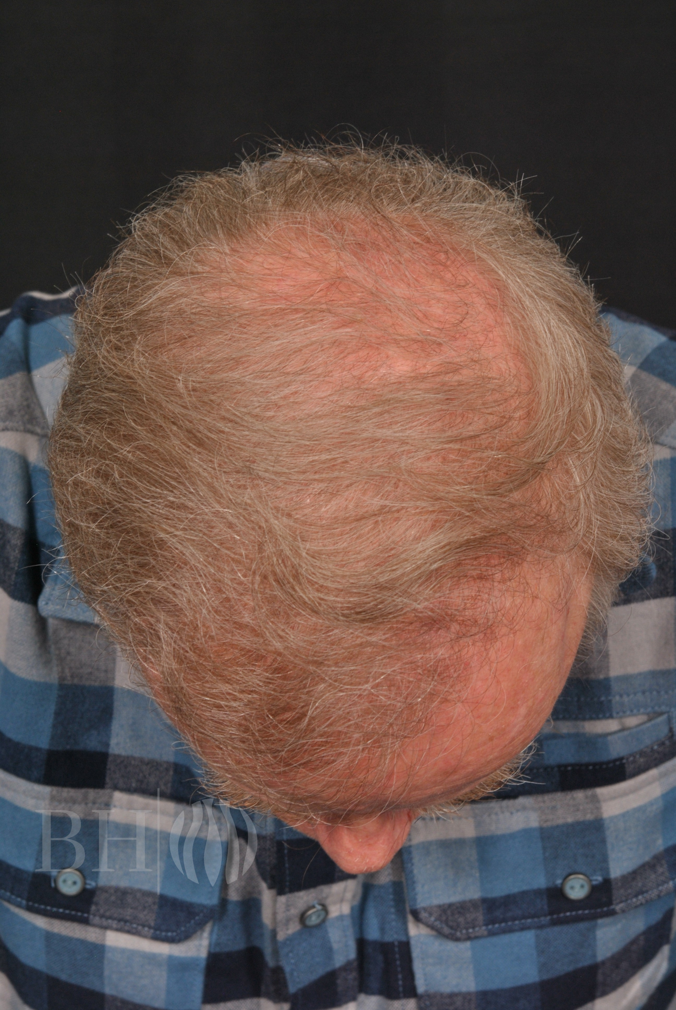 Neograft hair Before and After